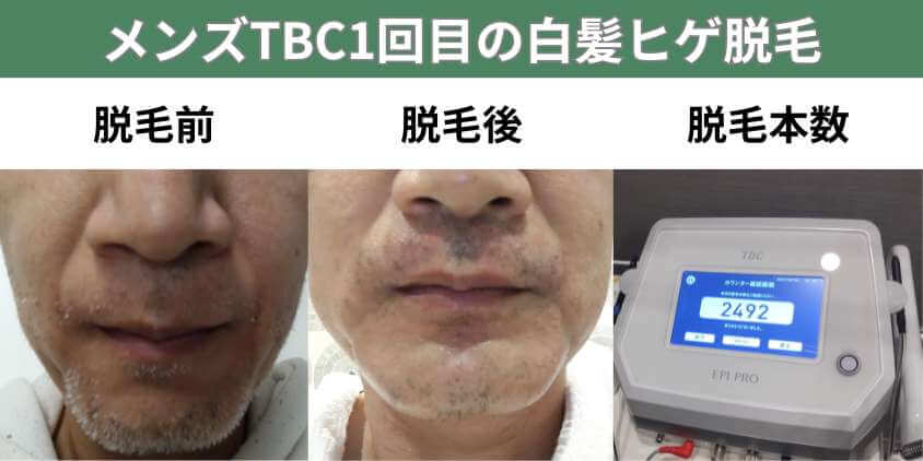 メンズTBC1回目の白髪ヒゲ脱毛