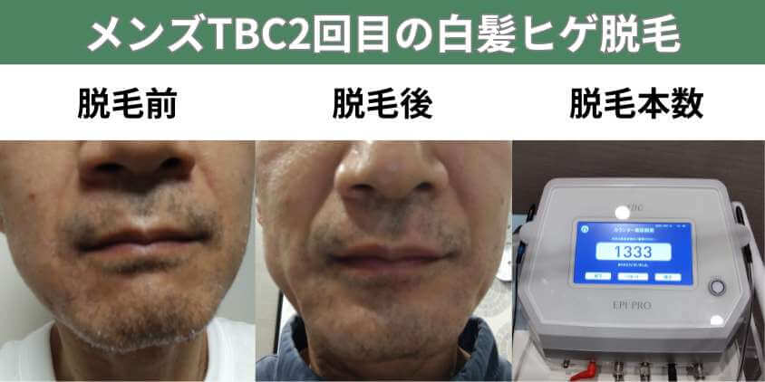 メンズTBC2回目の白髪ヒゲ脱毛