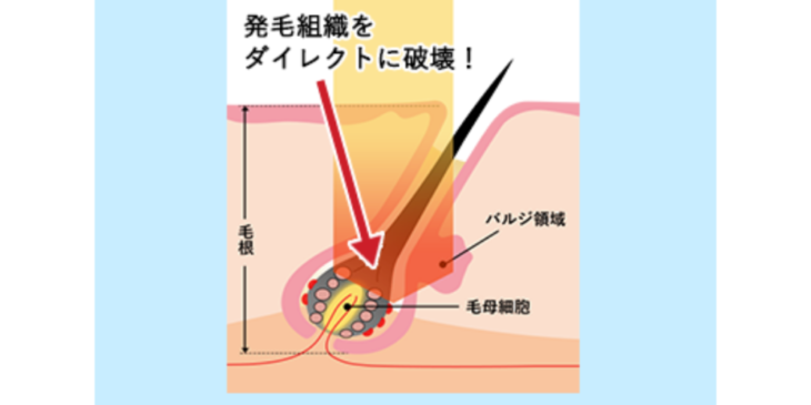 レーザー脱毛の照射の図解