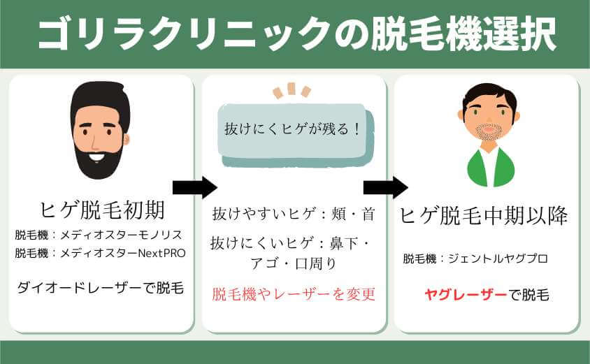 ゴリラクリニックの脱毛機選択