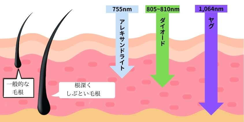 3種類のレーザー波長