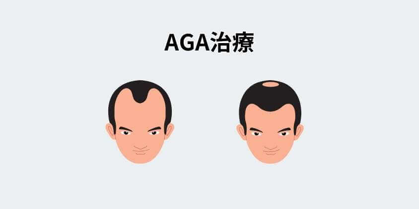 AGA治療