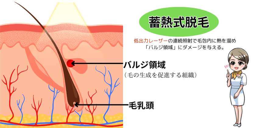 蓄熱式脱毛