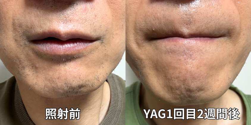 【ビフォーアフター写真】ゴリラクリニック ヤグレーザー