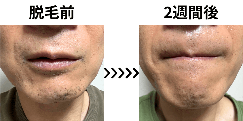 【ビフォーアフター】ヒゲ脱毛前・２週間後