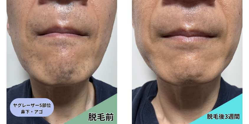 ヤグレーザー脱毛後の正面画像