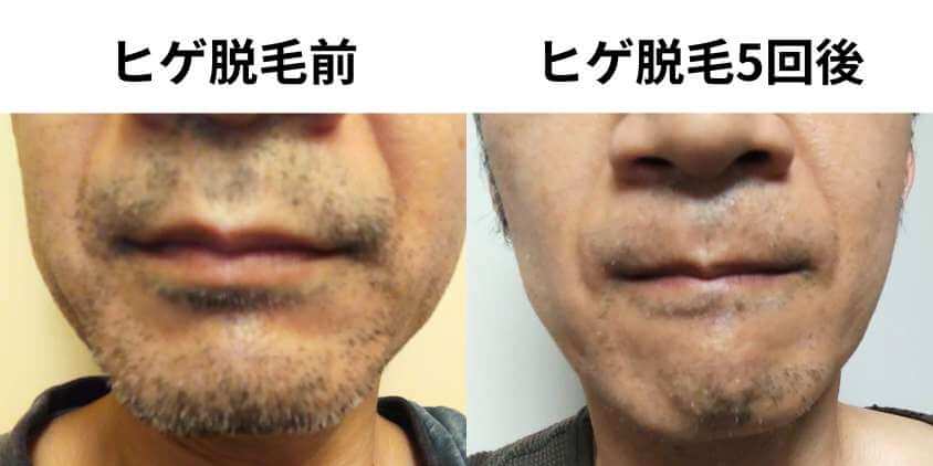 メンズエミナルヒゲ脱毛5回後のビフォーアフター