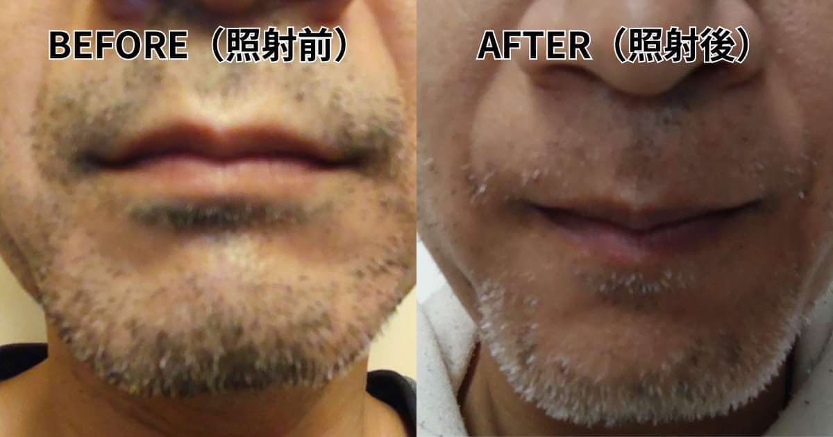 メンズエミナル8回後に白髪が残った40代男性の口元写真
