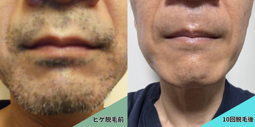 【写真】ヒゲ脱毛前／10回後
